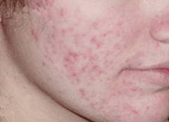 To Get Rid Of Dark Acne Scars Fast – Simple Techniques To Get Rid 