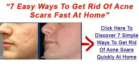  Acne Scars Naturally How To Treat Acne Scars Fast - Get Rid Of Acne